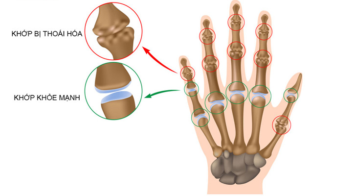 Khớp xương thoái hóa là nguyên nhân làm sưng khớp ngón tay
