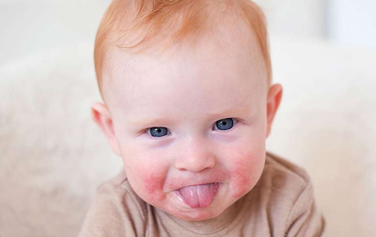 Bố mẹ cần lưu ý chăm sóc trẻ thật tốt để chữa dứt điểm mẩn đỏ quanh miệng