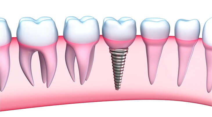 Trồng răng Implant có đau không phụ thuộc rất nhiều vào tay nghề bác sĩ, thiết bị công nghệ