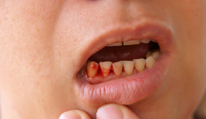 Chảy máu là biến chứng thường gặp nhất khi trồng răng