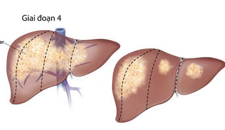 ung thư gan di căn xương