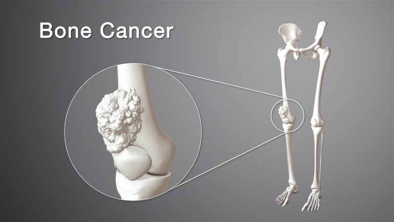 Ung thư xương có tính chất di truyền gián tiếp tức là thông qua một bệnh lý có tính di truyền nào đó