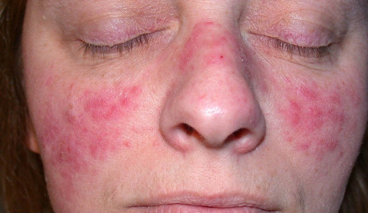 Hình ảnh người bị Lupus ban đỏ
