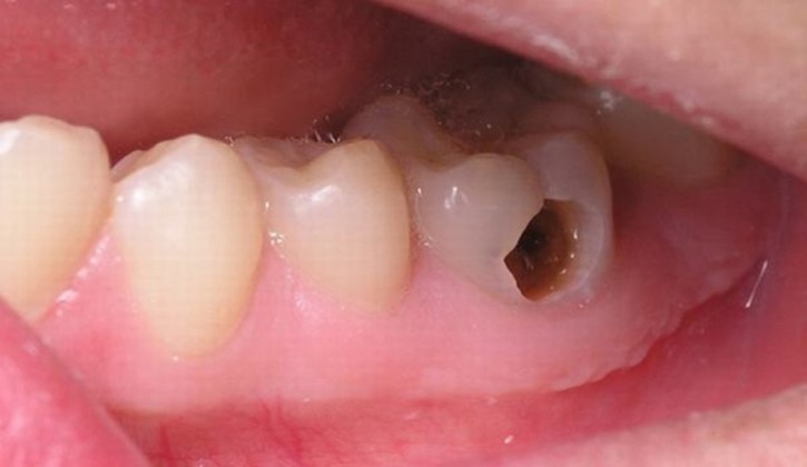Viêm Tủy Răng