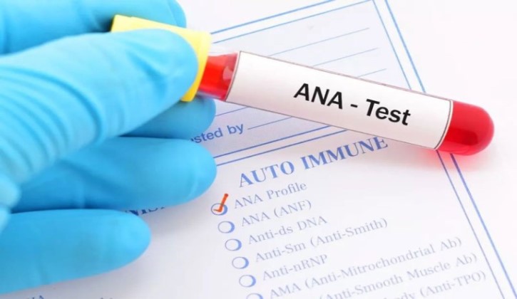 Kháng thể kháng nhân ANA là công cụ quan trọng để sàng lọc lupus ban đỏ