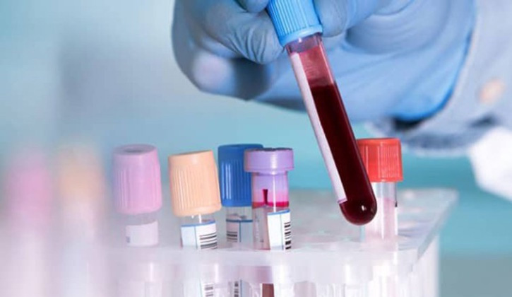 Xét nghiệm máu sẽ giúp xác định những chỉ số máu bất thường của bệnh nhân