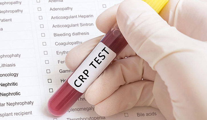Xét nghiệm CRP là phương pháp kiểm tra giúp đánh giá mức độ viêm