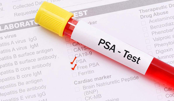 Chỉ số PSA toàn phần đánh giá nguy cơ ung thư