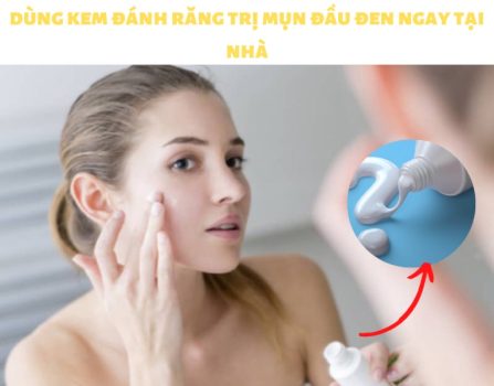 kem đánh răng trị mụn đầu đen