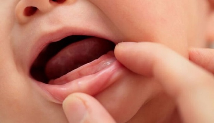 Bé không mọc răng đúng theo lộ trình có thể do yếu tố di truyền