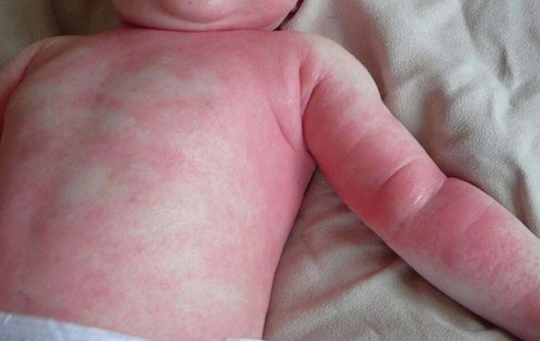 Thuốc kháng sinh dễ làm bé bị nổi mẩn đỏ không ngứa ở cổ, lưng, ngực