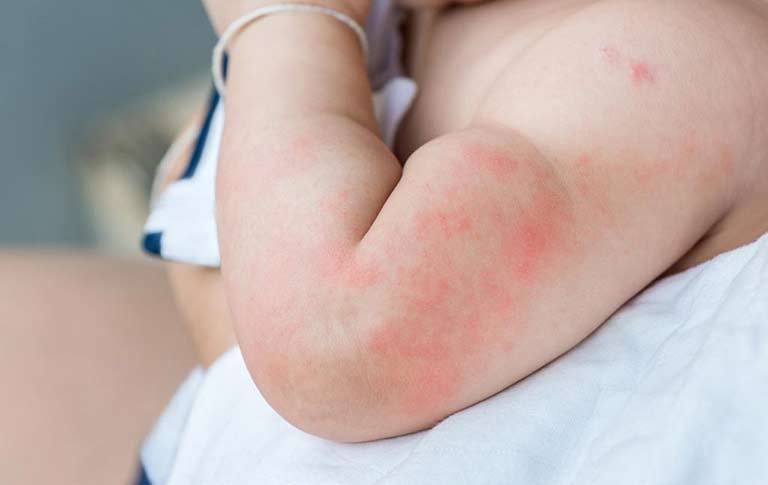 Viêm da tiếp xúc có thể làm trẻ nổi mẩn đỏ không ngứa