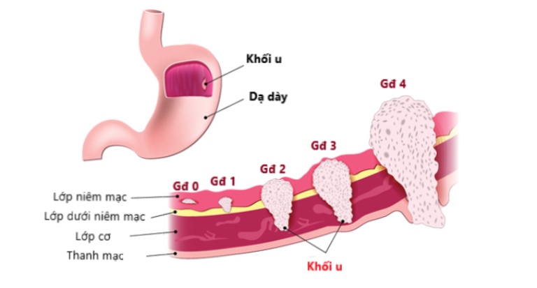 Các giai đoạn ung thư dạ dày