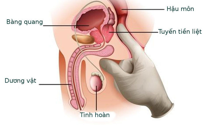 Khám qua trực tràng (DRE) là phương pháp chẩn đoán bệnh hiệu quả