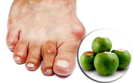 Chữa bệnh gout bằng quả dừa có tốt không?