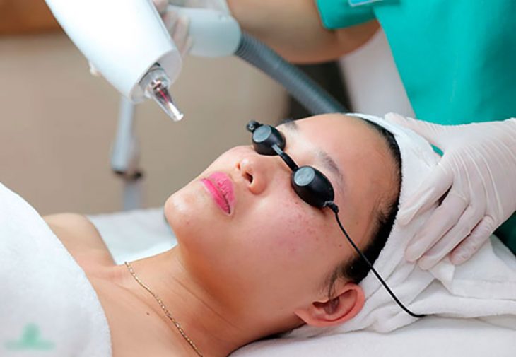 Cách điều trị đồi mồi trên da mặt bằng công nghệ Laser Yag