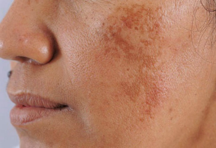 Nám mảng là nám dễ điều trị nhất trong các loại nám da