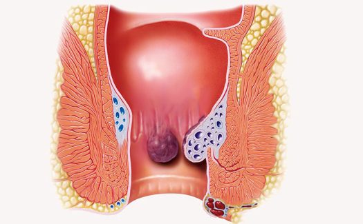 Cách phân biệt bệnh trĩ nội và trĩ ngoại