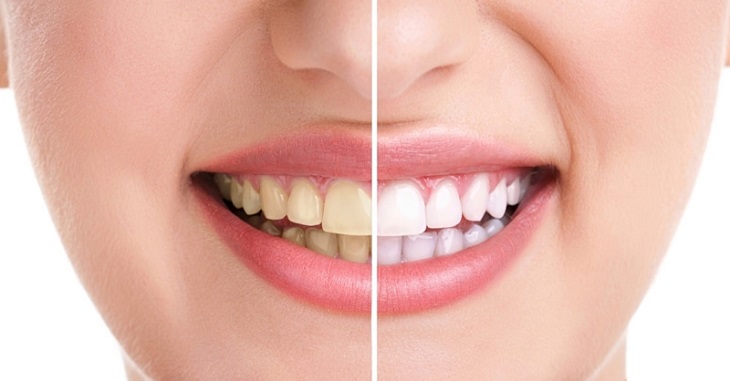 Hôi miệng và vàng răng là bệnh lý có nhiều nguyên nhân gây ra.