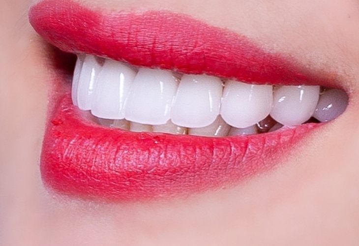 Cách trị răng ố vàng bằng phương pháp bọc sứ được nhiều người lựa chọn hiện nay