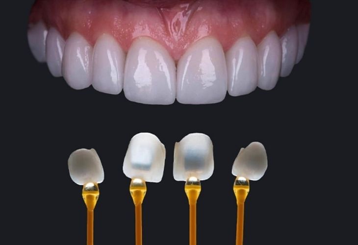 Dán sứ Veneer là phương pháp hiệu quả với các trường hợp có răng bị vàng lâu năm
