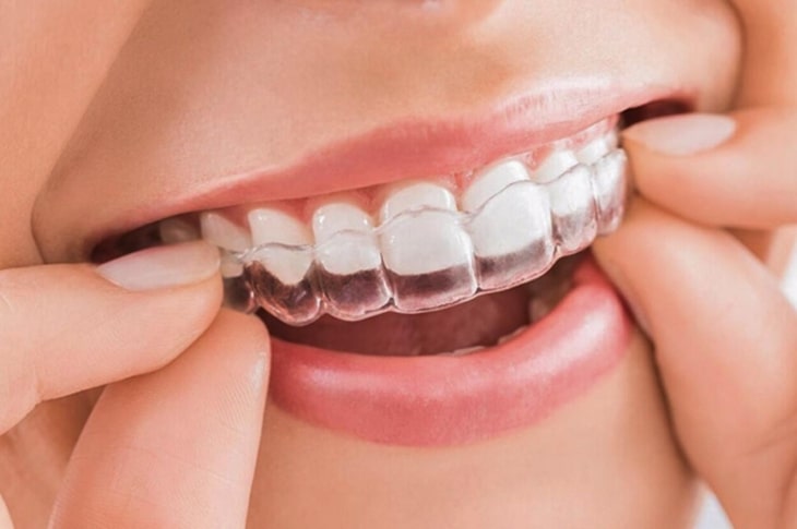 Chi phí niềng răng 1 hàm phụ thuộc vào từng độ tuổi khác nhau