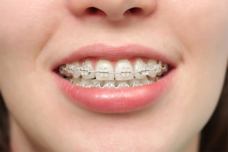 Tình trạng răng càng phức tạp thì chi phí niềng răng 2 hàm sẽ càng cao