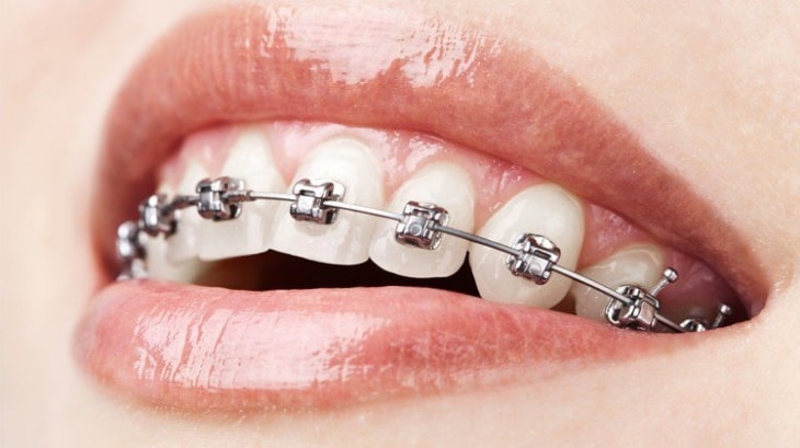 Niềng răng mắc cài kim loại là phương pháp phổ biến nhất hiện nay