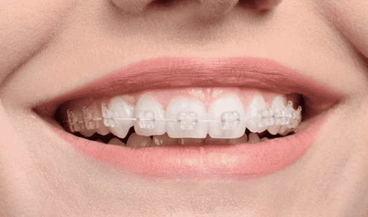 Niềng răng 2 hàm mắc cài sứ giúp bạn không sợ bị lộ mắc cài