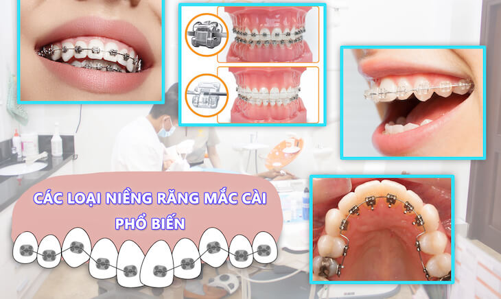 Các loại dịch vụ niềng răng mắc cài hiện nay