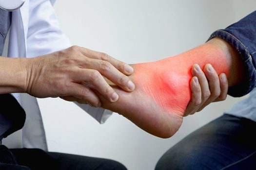 Bệnh gout gây ra triệu chứng đau nhức, sưng đau