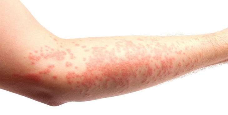 Bệnh mề đay thể thấp nhiệt có biểu hiện là da nổi mẩn đỏ liền nhau