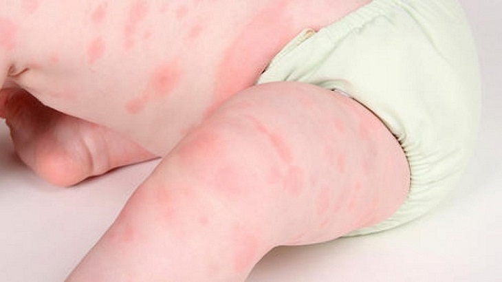 Làn da của trẻ thường mỏng và nhạy cảm nên dễ mắc bệnh mề đay