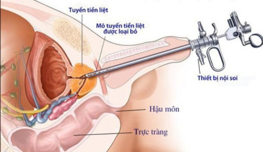 Nội soi cắt u phì đại tuyến tiền liệt là phương pháp nhiều ưu điểm