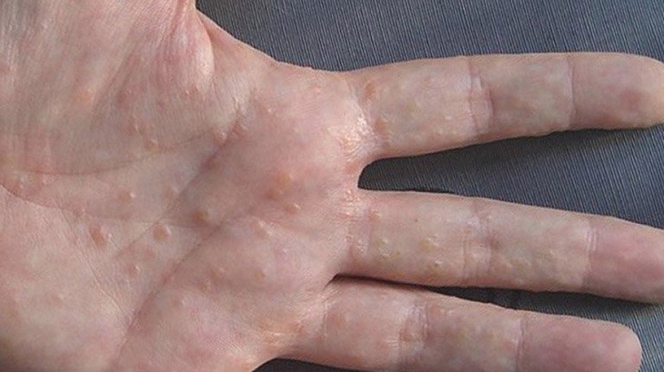 Bệnh tổ đỉa xuất hiện nhiều ở khu vực lòng bàn tay, bàn chân