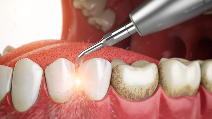 Một vài trường hợp cần lấy cao răng để điều trị