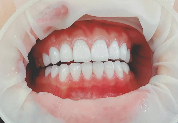 Người bệnh cần có sức khỏe răng miệng tốt để dán sứ