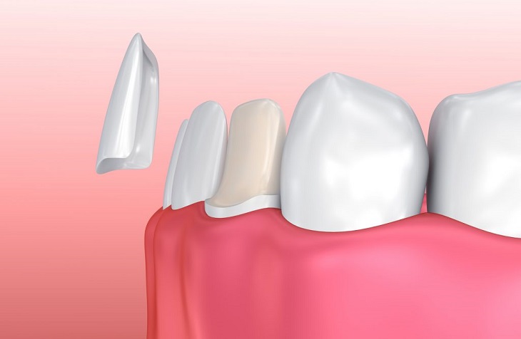Giá thực hiện dán răng phụ thuộc nhiều vào chất liệu loại răng