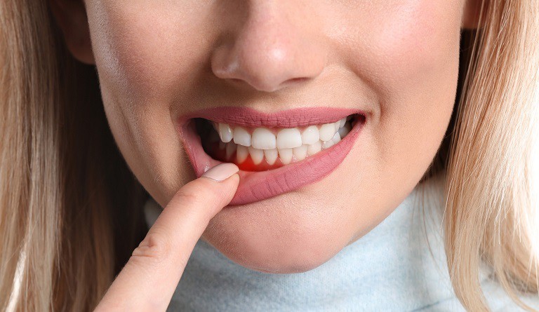 Khi bị viêm nha chu thì không nên dán răng sứ