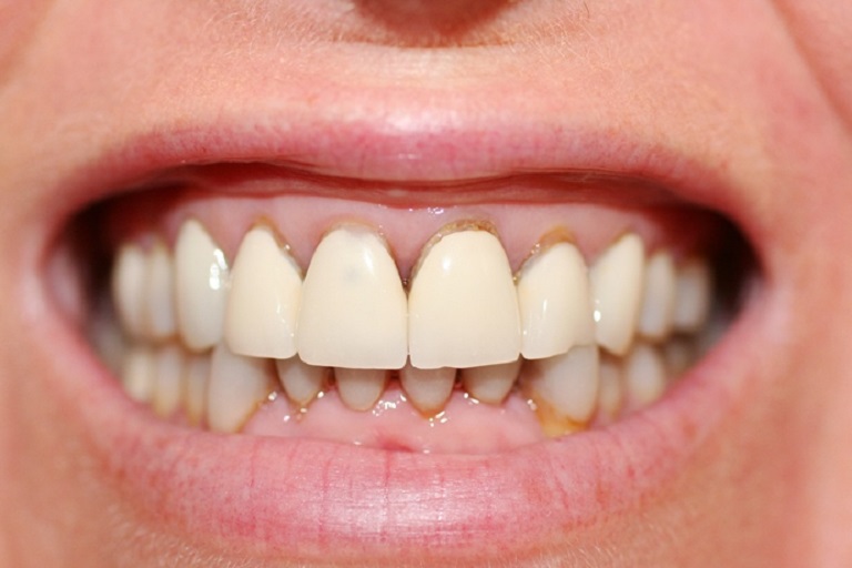 Răng sứ Veneer lắp dán không đảm bảo chất lượng
