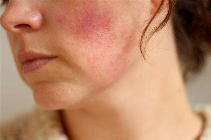 Biểu hiện dị ứng da mặt thường xuất hiện các mẩn đỏ trên da
