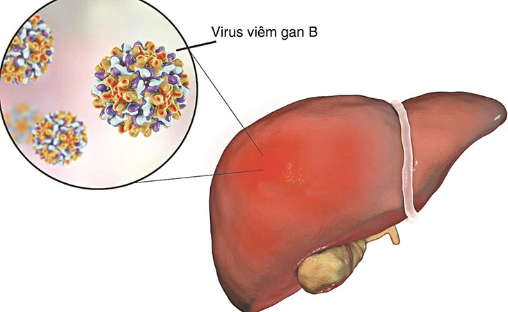 Xét nghiệm định lượng viêm gan B là đo tải lượng virus HBV trong máu