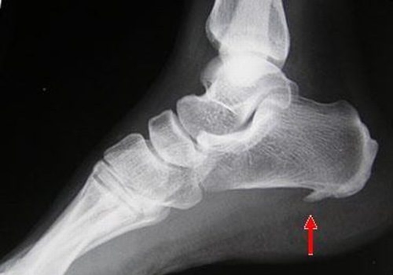 Gai gót chân phát triển lớn sẽ gây ra triệu chứng đau nhức ở lòng bàn chân
