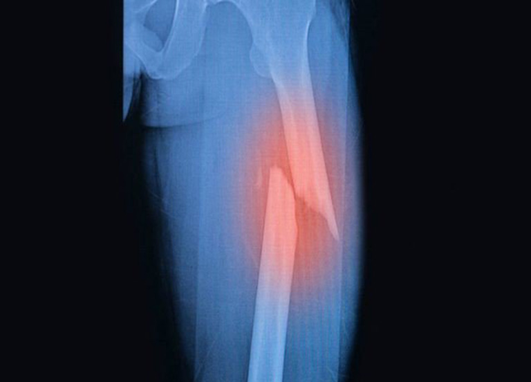 Hình ảnh x-quang cho thấy xương chày bị gãy