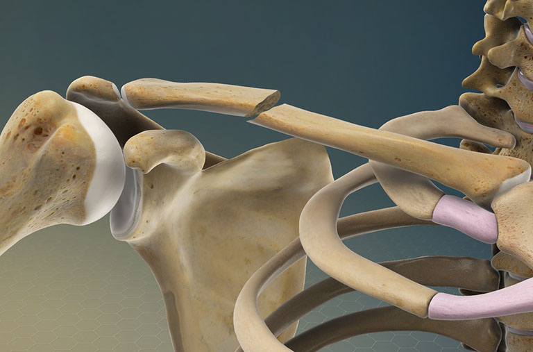Gãy xương đòn cần được xử lý đúng cách để tránh ảnh hưởng đến các cơ quan khác