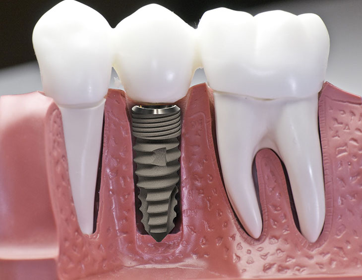 Giá trồng răng bằng phương pháp implant được đánh giá khá cao