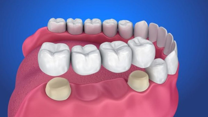 Giá trồng răng bằng phương pháp implant được đánh giá khá cao