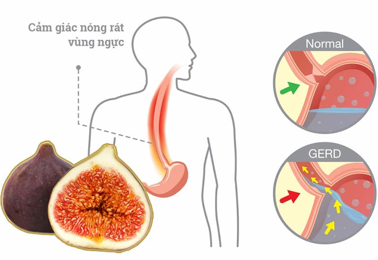 Người bị dạ dày nên hỏi bác sĩ trước khi sử dụng quả sung điều trị sỏi thận 