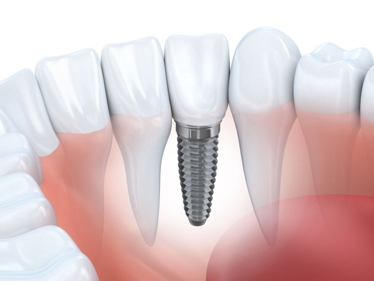 Trụ răng Implant Hàn Quốc được đánh giá cao về chất lượng