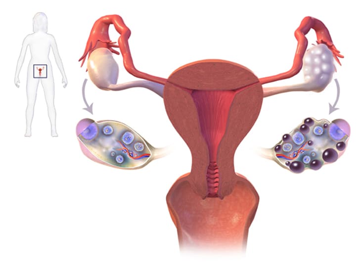 PCOS - Buồng trứng đa nang ở phụ nữ